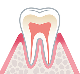 歯周炎（初期）　歯周ポケット3～4mm