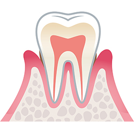 歯周炎（中期）　歯周ポケット4～6mm
